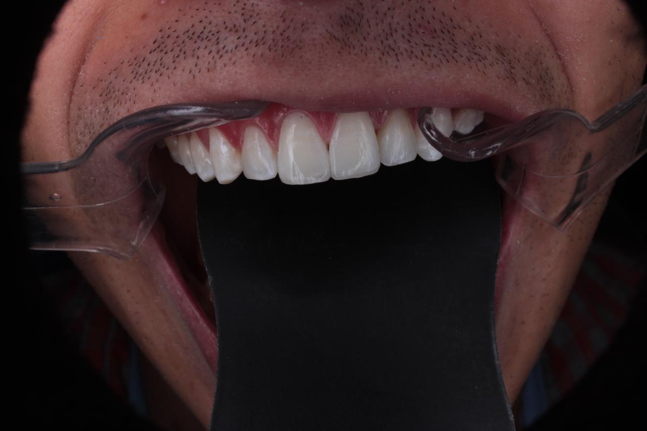Diseño de sonrisa digital · planificación DSD