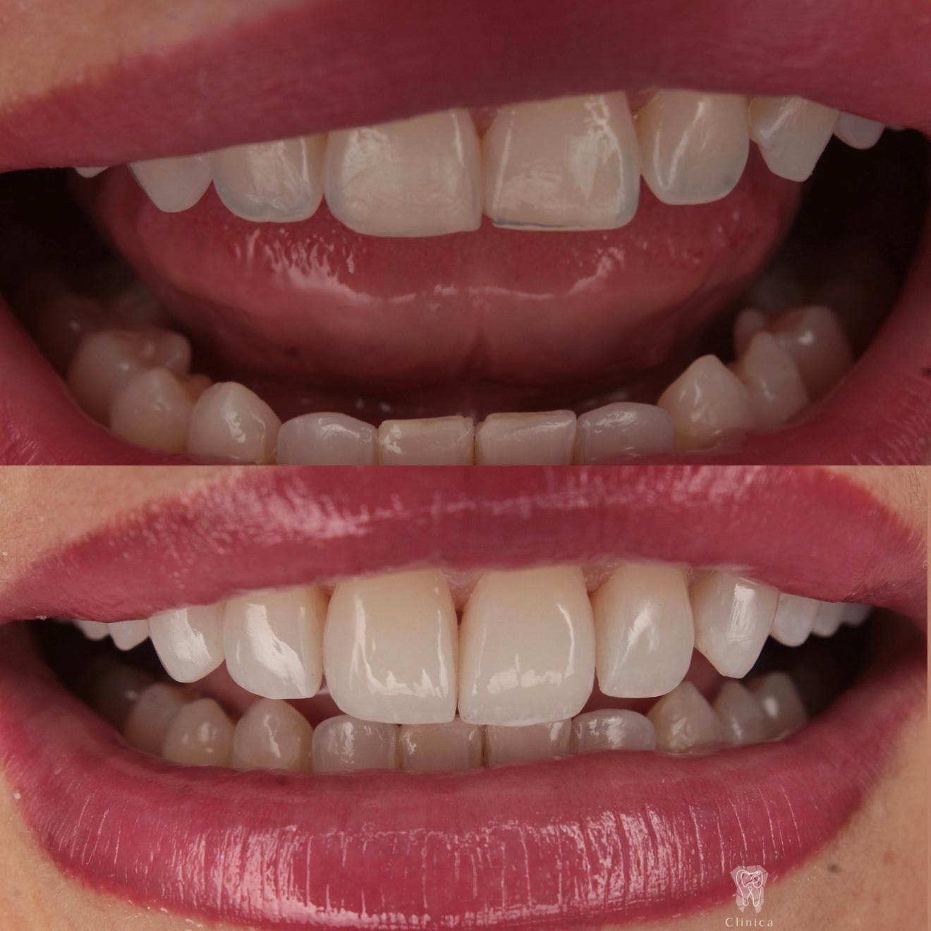 Armonización orofacial · toxina botulínica