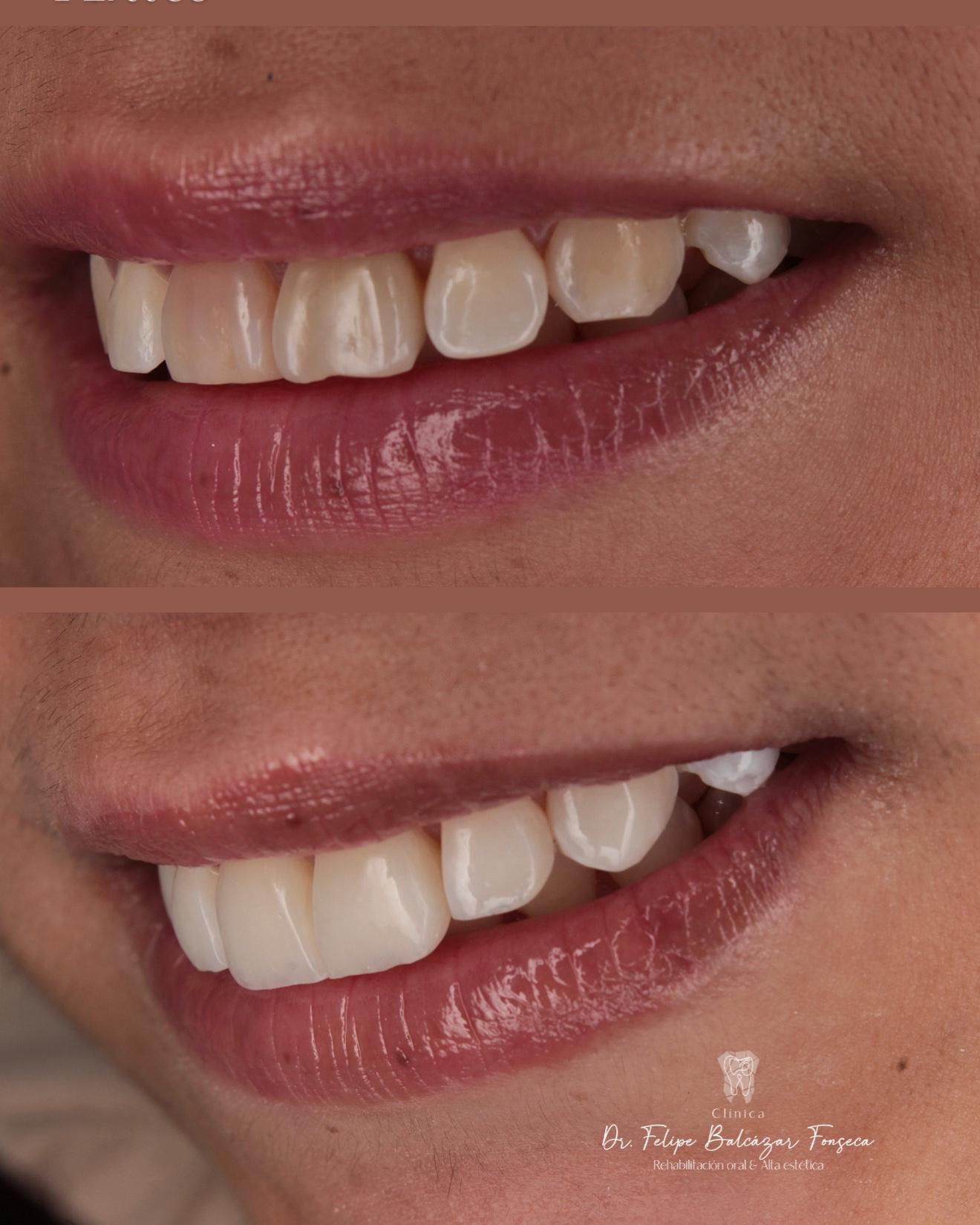 Cirugía oral · extracción de tercer molar