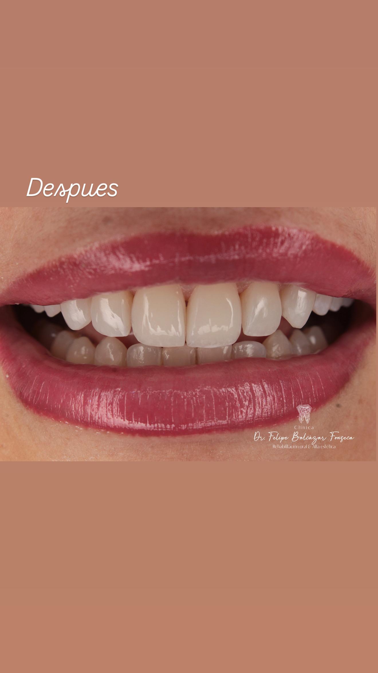 Diseño de sonrisa · carillas de porcelana