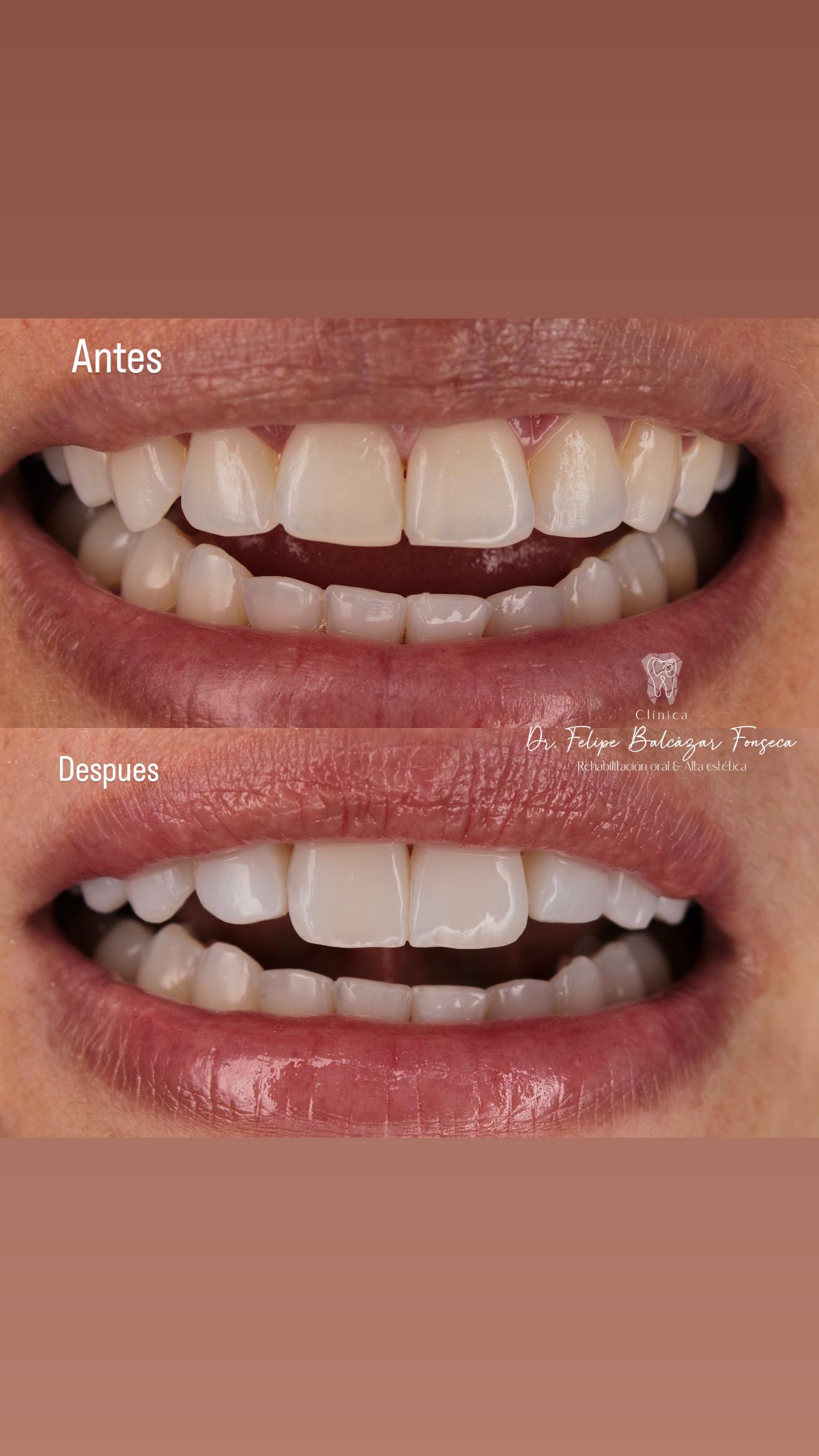 Blanqueamiento dental · resultado inmediato