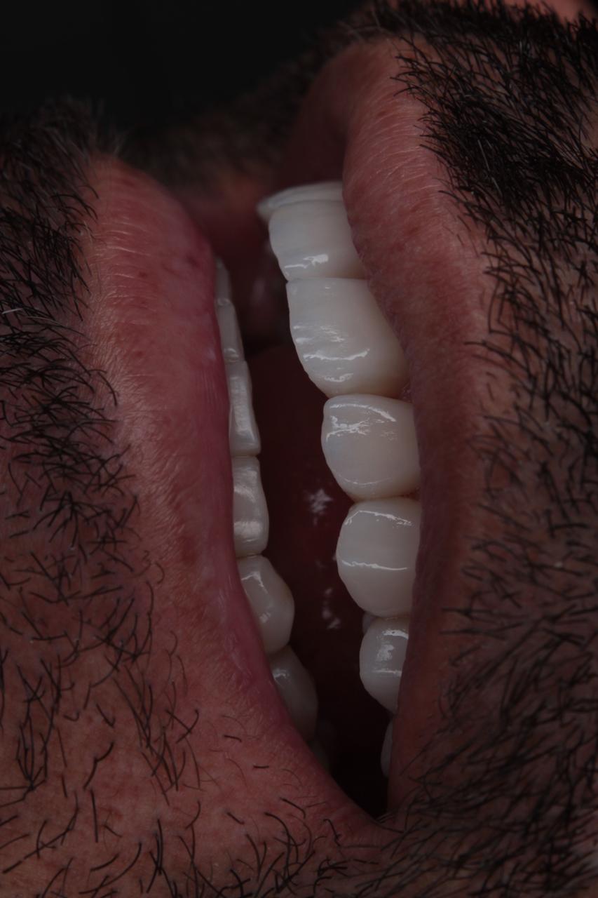 Resultado final · rehabilitación oral completa