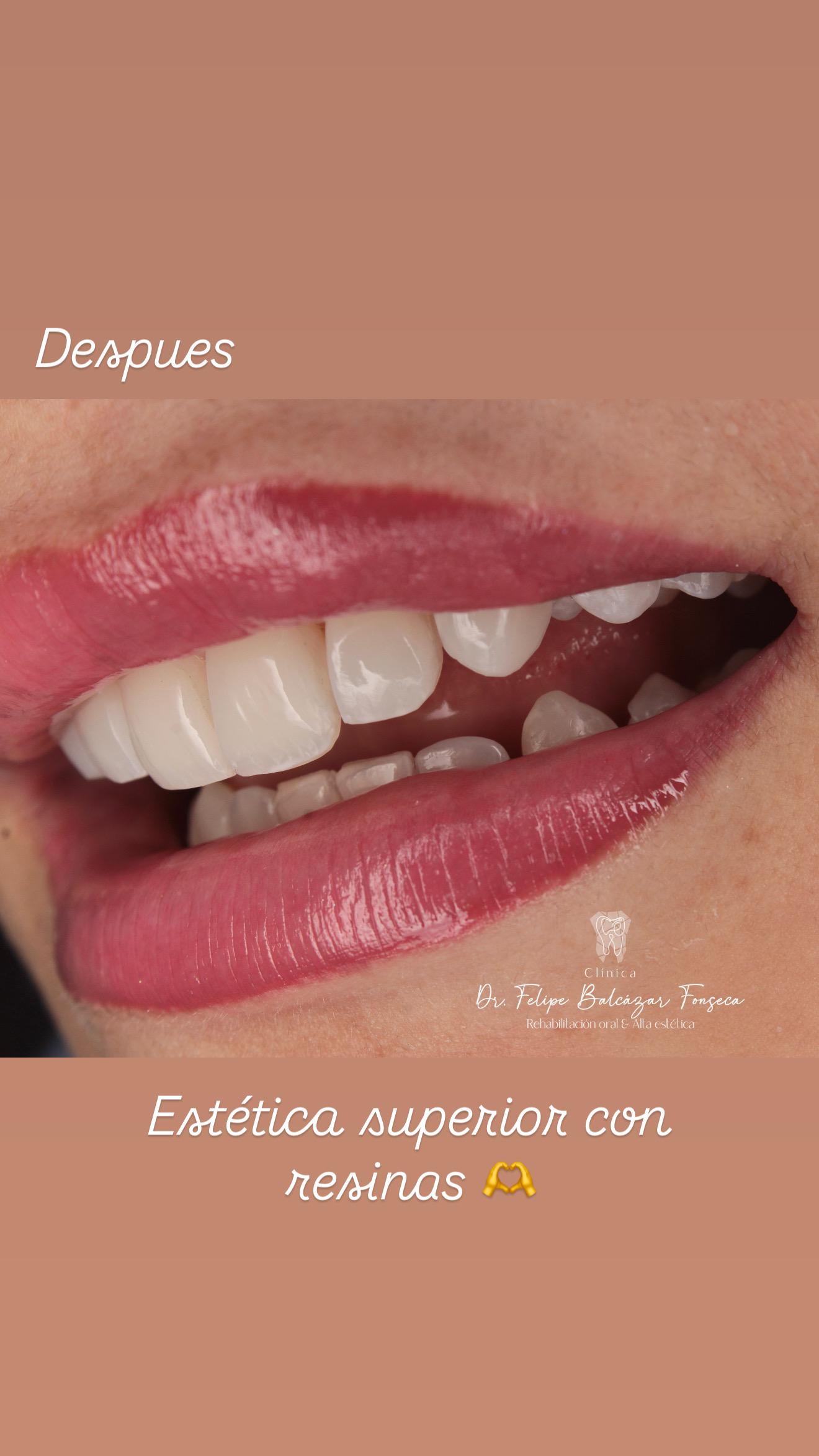 Blanqueamiento dental · antes y después