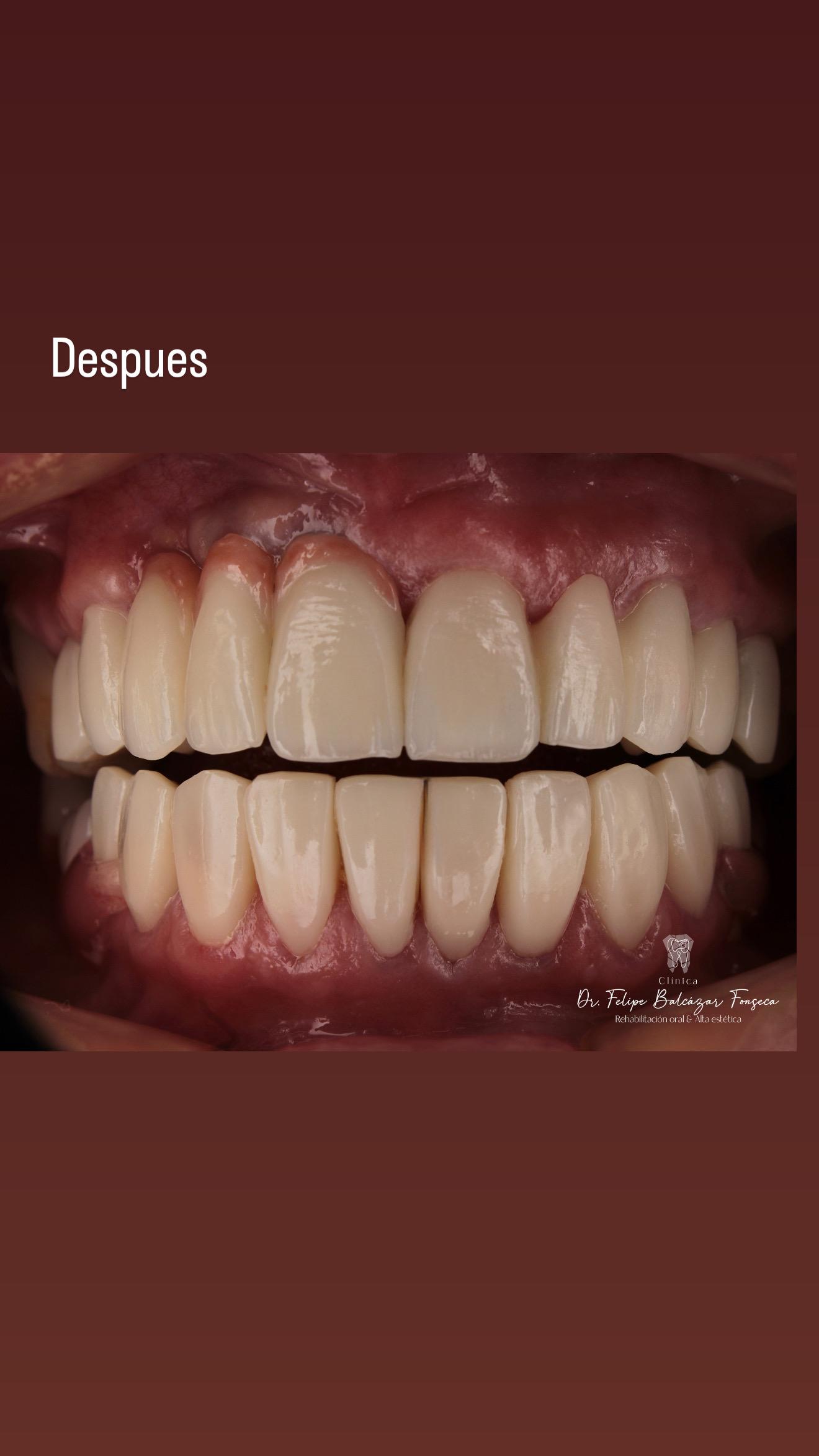 Armonización de sonrisa · caso estético integral