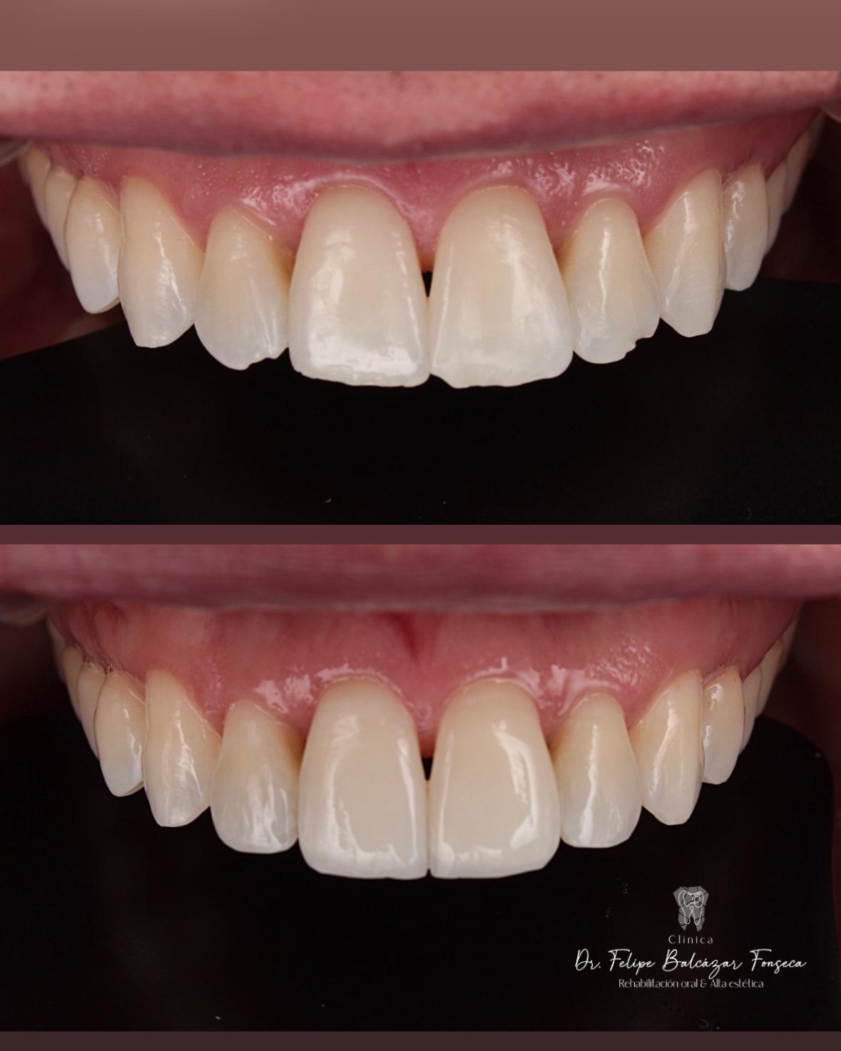 Rehabilitación sobre implantes múltiples