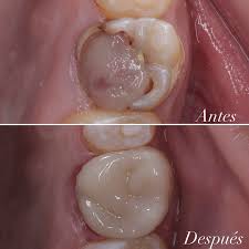 Endodoncia
