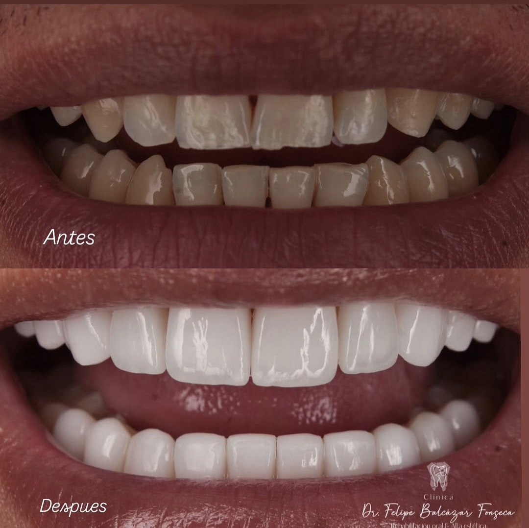 Estética Dental