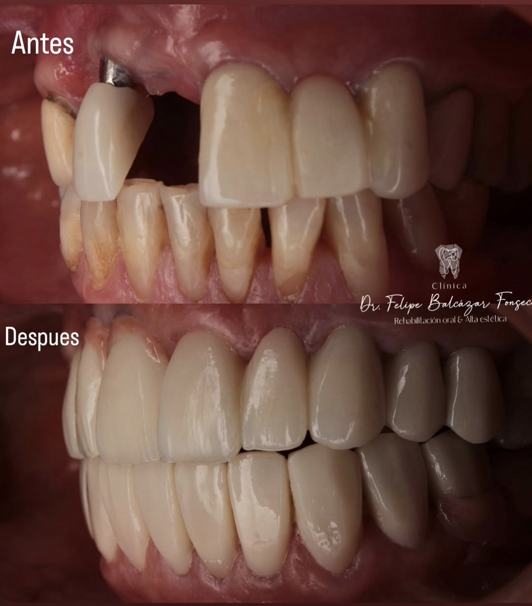 Implantología Oral