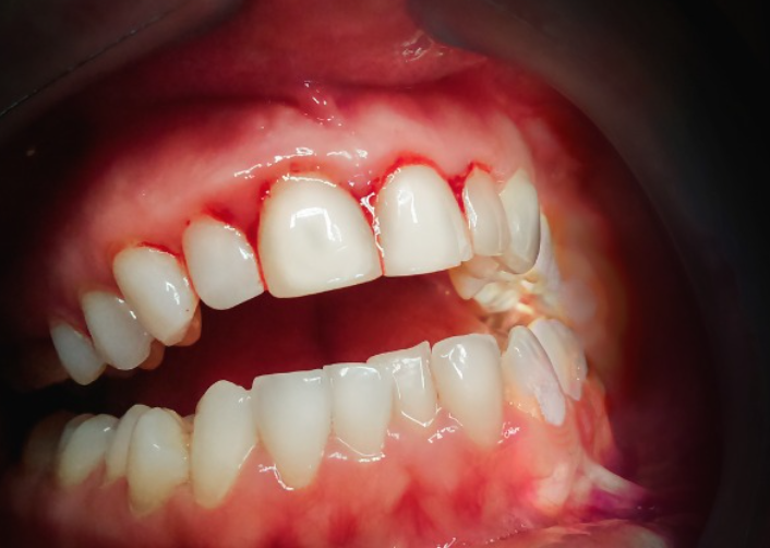 Periodoncia